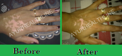 vitiligo treatment UK